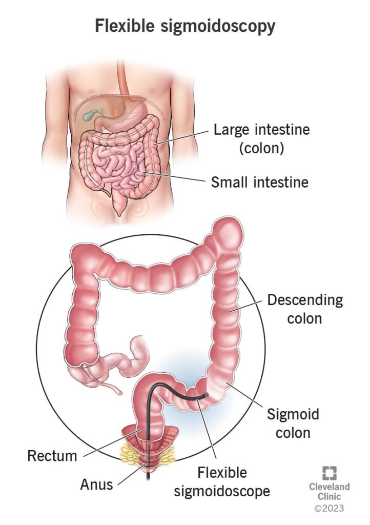 Flexible sigmoidoscopy diagram showing colon, rectum, and sigmoid colon by Dr. Lunia Best Gastroenterologist in Raipur