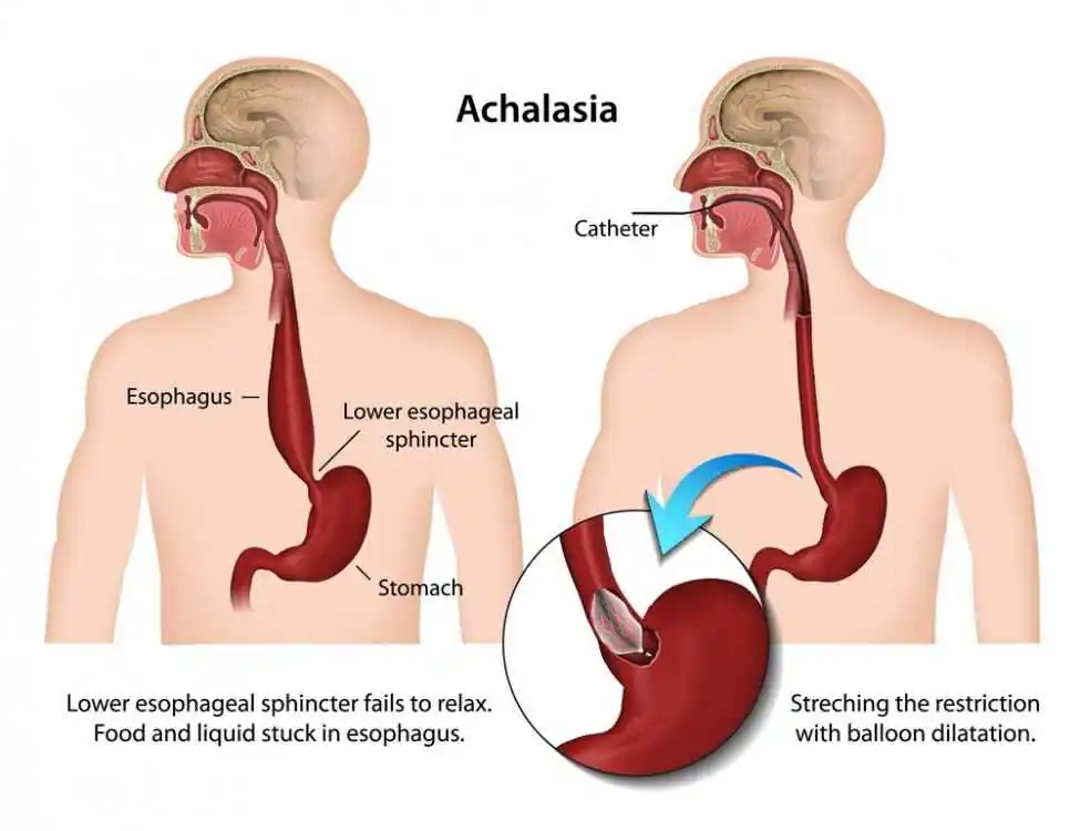 Achalasia diagram showing esophagus, lower esophageal sphincter dysfunction and balloon dilation treatment