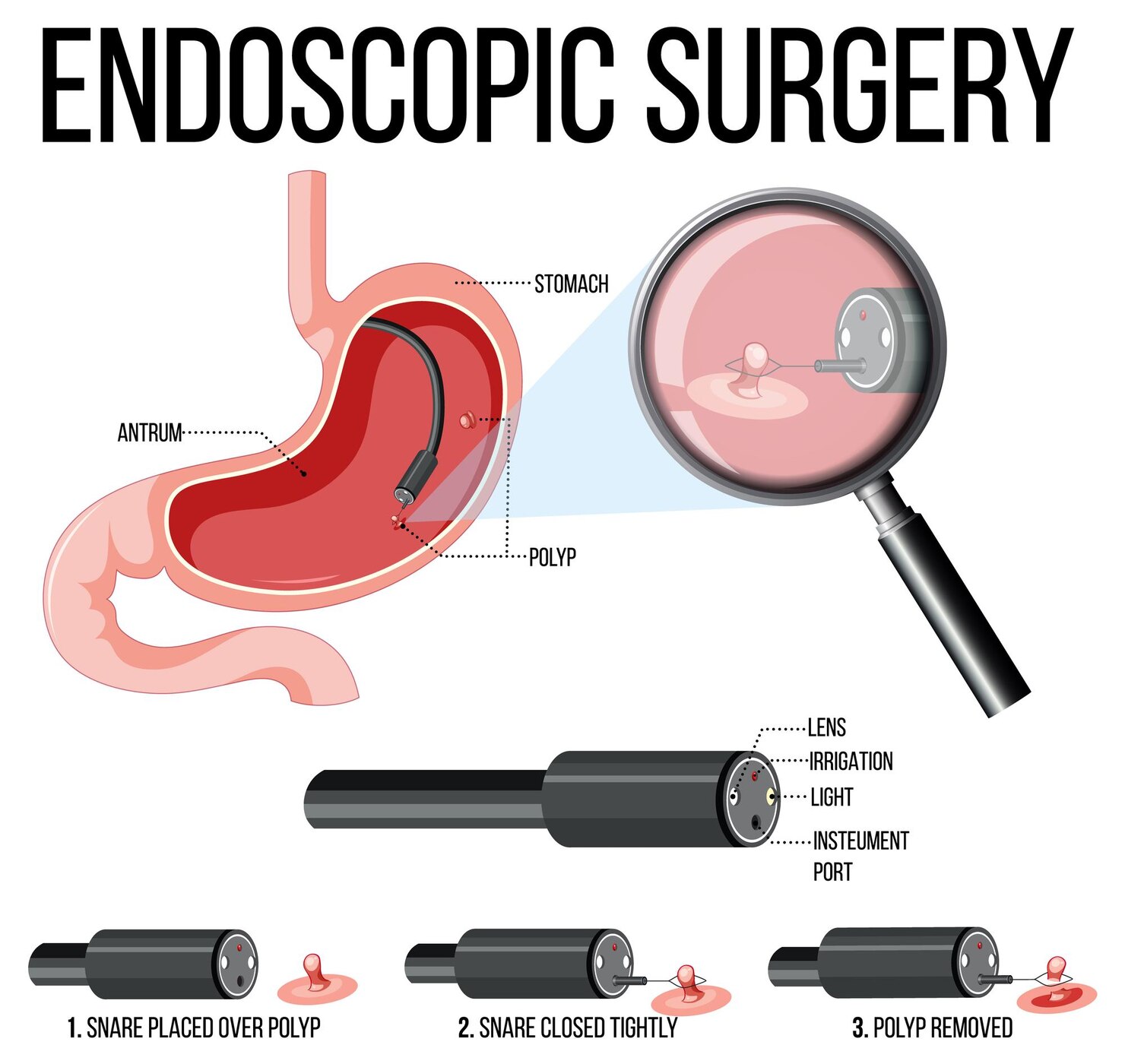 Endoscopic surgery procedure illustration for stomach polyp removal by gastroenterologist in Raipur