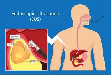 Endoscopic ultrasound EUS procedure showing pancreas and tumor diagnosis by gastroenterologist in Raipur
