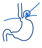 “Hiatus hernia icon showing stomach and esophagus condition by Dr Manish Lunia Gastroenterologist and Hepatologist in Raipur”